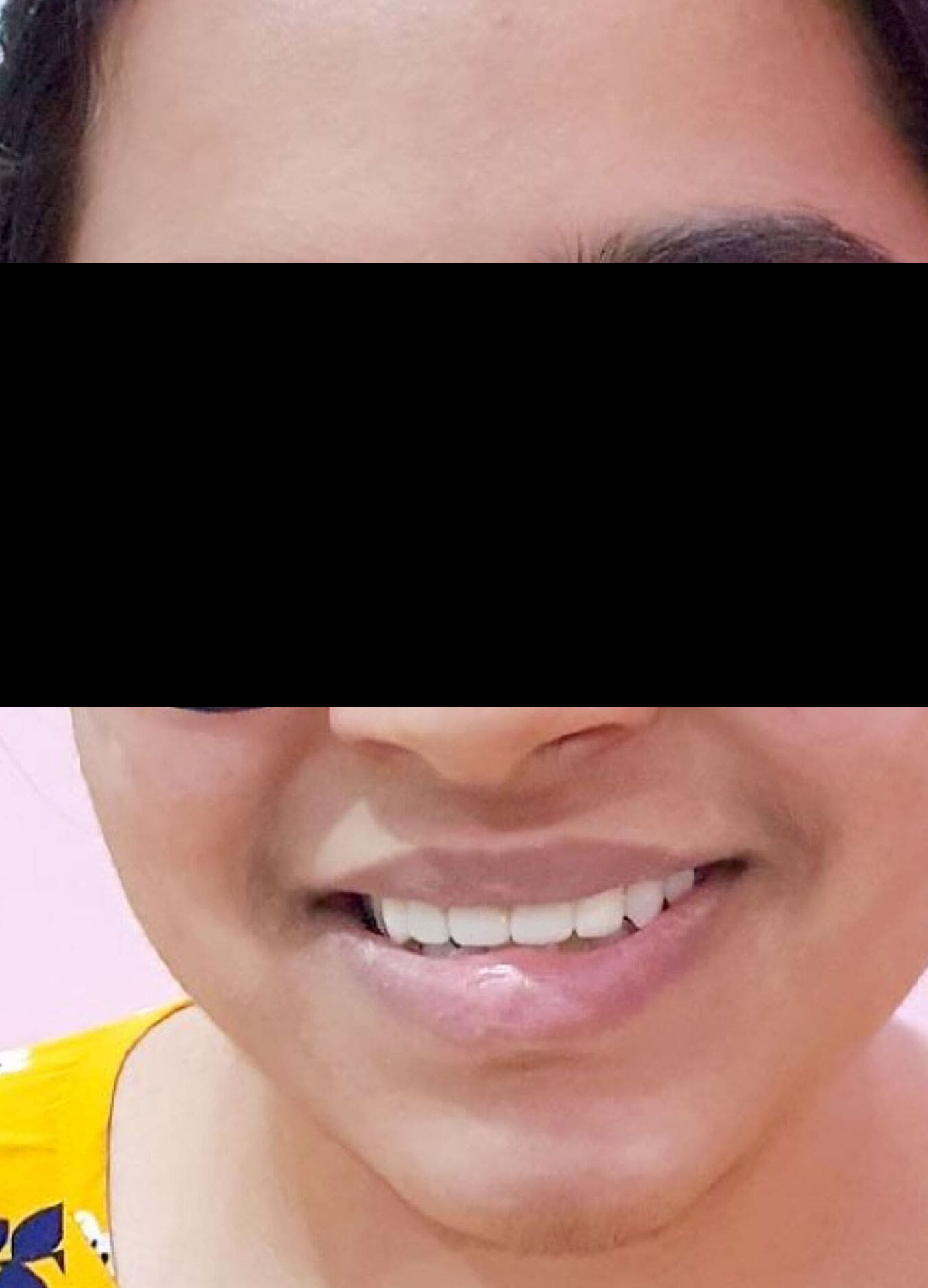 After Fixed Tooth Treatment